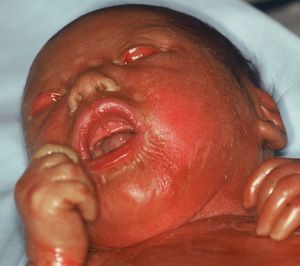Collodion baby that subsequently progressed to a lamellar ichthyosis phenotype.