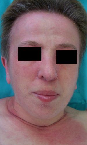 Dermatomyositis and breast cancer (facial erythema).
