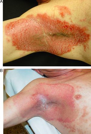 A, 56-year-old patient with severe Hailey-Hailey disease affecting both axillae. B, Photograph taken 1 month after treatment with carbon dioxide laser skin resurfacing. Note the considerable improvement in lesions and the small area of local recurrence in the armpit. The patient decided not to undergo partial treatment of this small area in a second laser session.