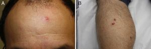 A, Erythematous papule without crust. B, Multiple lesions on a patient