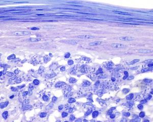 Numerous histiocytes in the papillary dermis with Leishmania parasites in the cytoplasm (Giemsa, original magnification×1000).