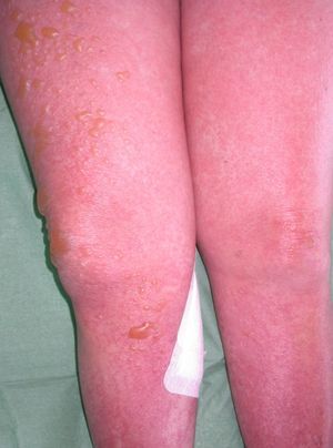 Erythematous papules coalesced to form firm plaques on the lower limbs, accompanied by blisters filled with clear fluid.