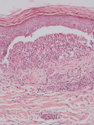 Dermoepidermal detachment with a neutrophil-rich inflammatory infiltrate. Hematoxylin-eosin, original magnification ×10.