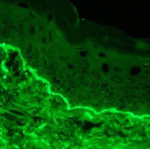 Linear deposit of IgA along the basement membrane (direct immunofluorescence, original magnification ×10).