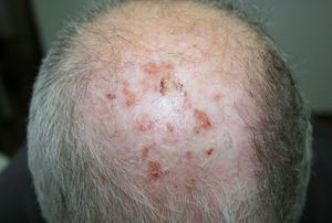 Active lesions of erosive pustular dermatosis of the scalp together with actinic keratoses.