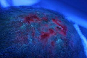 Intense uptake by actinic keratoses as well as by the lesions of erosive pustular dermatosis of the scalp.