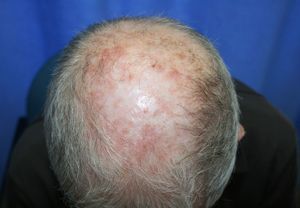 Note the improvement after 2 sessions of PDT.