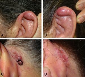 A, Angiolymphoid hyperplasia lesion before treatment. B, Angiolymphoid hyperplasia lesion after treatment with intralesional corticosteroids. C, Original retroauricular angiolymphoid hyperplasia lesion. D, Angiolymphoid hyperplasia lesion that recurred after surgery.