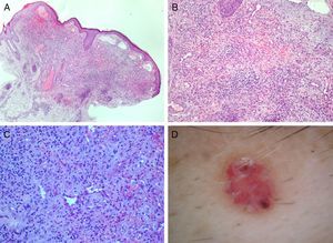 Histologic features of angiolymphoid hyperplasia. A, Hematoxylin-eosin, original magnification ×40. B, Hematoxylin-eosin, original magnification ×100. C, Hematoxylin-eosin, original magnification ×200. D, Dermoscopic image of angiolymphoid hyperplasia.