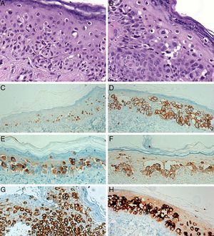 A and B, Histologic images of the lesion showing isolated clear cells in the epidermis (hematoxylin-eosin, original magnification ×400). C, Nuclear expression of estrogen receptors in the atypical cells (hematoxylin-eosin, original magnification ×200). D, Intense Her2 membrane staining (hematoxylin-eosin, original magnification ×200). E, The intraepidermal tumor cells were positive for carcinoembryonic antigen (hematoxylin-eosin, original magnification ×200). F, Cytoplasmic staining for MUC1 (hematoxylin-eosin, original magnification ×200). G, Cytoplasmic staining for cytokeratin 7 (hematoxylin-eosin, original magnification ×200). H, Gross cystic disease fluid protein 15 is positive in EMPD (hematoxylin-eosin, original magnification ×200).