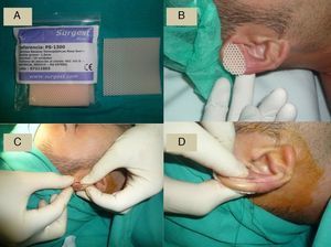 A, Thermoplastic splint of 1.6mm thickness before placing in hot water. B, Splint trimmed to size. C, The splint is placed on either side of the ear and manual compression is applied for a few seconds until it hardens. D, Button suture on both sides of the ear.