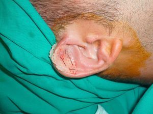 Final result after placement of the splint on both sides of the ear.