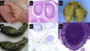A, Cutaneous squamous cell carcinoma on the external ear of a 70-year-old patient. B, Fleshy tumor invading the external auditory canal. C and D, Histology showing a poorly differentiated squamous cell tumor with lymphovascular invasion (C, hematoxylin-eosin, original magnification x40; D, Immunostaining with CD31, original magnification x100); E, Parotid gland with nodular tumor. F, The parotid tumor is formed by a proliferation of poorly differentiated squamous cells in a pattern similar to that of the primary tumor (original magnification, hematoxylin-eosin, x40).