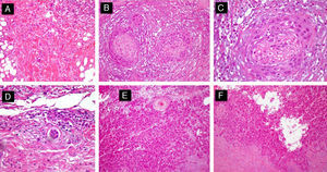 Different histologic subtypes associated with high-risk cutaneous squamous cell carcinoma. A, Isolated-cell pattern (hematoxylin-eosin, original magnification x40). B and C, Squamous cell carcinoma with perineural invasion (nerves >0.1mm) (hematoxylin-eosin, original magnification x40 [B] and x100 [C]). D, Squamous cell carcinoma with marked lymphovascular invasion (hematoxylin-eosin, original magnification x100). E, Adenoid squamous cell carcinoma (hematoxylin-eosin, original magnification x40). F, Acantholytic squamous cell carcinoma (hematoxylin-eosin, original magnification x40).