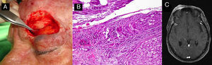 A, Perineural invasion detected incidentally during surgery. B, Histology showing invasion of the nerve trunk (diameter, >0.1mm) by atypical squamous cells (hematoxylin-eosin, original magnification x40). C, Magnetic resonance image showing intracranial invasion of the tumor along the nerve pathway.