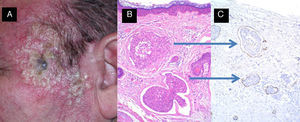 Carcinomatous lymphangitis secondary to squamous cell carcinoma previously excised from the left temple. A, Multiple papulous vesicles on the left temple. B and C, Invasion of lymph vessels by atypical squamous cells (B, Hematoxylin-eosin, original magnification x40; C, Immunostaining with D2-40, original magnification x40).