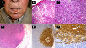 High-risk squamous cell carcinoma studied by sentinel lymph node biopsy. A, Squamous cell carcinoma of the lower lip in a 65-year-old man. B and C, Atypical squamous cell proliferation with acantholysis and perineural invasion. D-F, Invasion of sentinel lymph node by atypical squamous cells (hematoxylin-eosin, original magnification x40 [D] and x100 [E]; immunostaining with pankeratin, original magnification x100 [F]).