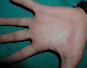 Case 1. Palmar pitting.