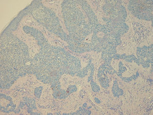 Case 5. Hematoxylin-eosin, original magnification x20. BCC in the form of strings (basaloid proliferation comprising cells with scant cytoplasm arranged in nests with peripheral palisading, necrosis, and focalized central calcification infiltrating the superficial dermis).