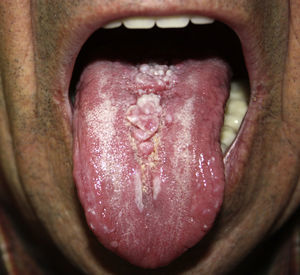 Lobulated, elastic, pink-colored lesion on the midline of the dorsum of the tongue.