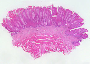 Papillomatous acanthosis with hyperkeratosis and foci of parakeratosis (hematoxylin-eosin, original magnification x2).