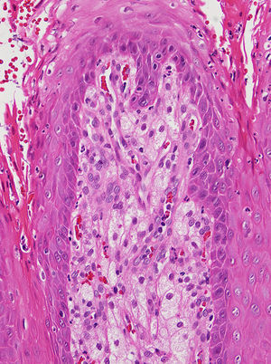 Dermal papillae with numerous foamy histiocytes. Neutrophils are present in the foci of parakeratosis (hematoxylin-eosin, original magnification x20).