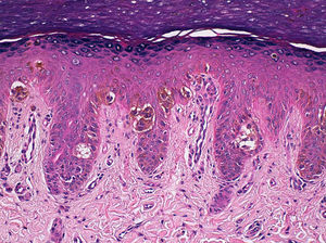 Epidermal hyperplasia and a proliferation of melanocytes with small nuclei and no atypia or pleomorphism; the melanocytes were arranged in nests of different sizes in the deep part of the epithelium and also as individual cells with a pagetoid distribution in the superficial layers of the epithelium (hematoxylin-eosin, original magnification x100).