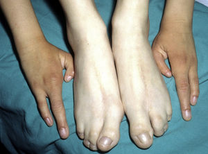 Two limb abnormalities most characteristic of ectrodactyly-ectodermal dysplasia-cleft lip/palate syndrome.