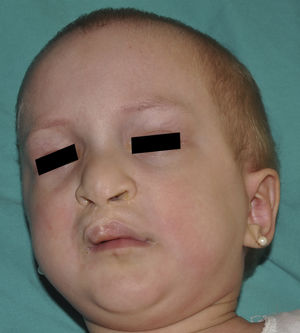 Shorter eyelid skin crease, sparse hair, and (surgically repaired) cleft lip in a patient with ankyloblepharon-ectodermal dysplasia-cleft lip/palate syndrome.