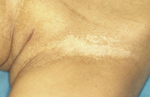 Abnormal pigmentation in the inguinal fold, with areas of hypopigmentation in the central part of the fold and areas of reticular hyperpigmentation in the peripheral areas and on the vulva in a patient with ankyloblepharon-ectodermal dysplasia-cleft lip/palate syndrome.