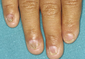 Fingernail abnormalities of varying severity in a patient with ankyloblepharon-ectodermal dysplasia-cleft lip/palate syndrome.