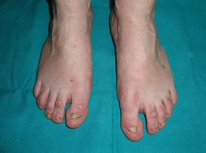 Hidrotic ectodermal dysplasia. Toenail dystrophy (courtesy of Dr. Isabel Febrer).