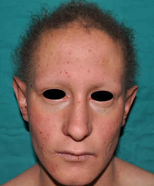 Ectodermal dysplasia-fragile skin syndrome. The patient has short, sparse, curly hair, diffuse erythema, fissured cheilitis, and areas of erosions. Currently, this syndrome has been reclassified as a simple epidermolysis bullosa.