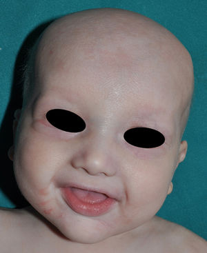 X-linked hypohidrotic ectodermal dysplasia with alopecia universalis of the scalp, eyebrows, and eyelashes in an infant. Also of note is the frontal bulging, lip eversion, and discrete perioral eczematiform lesions.