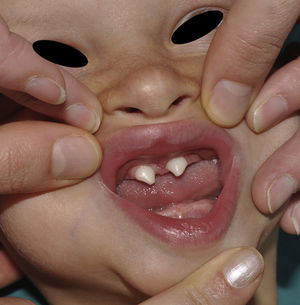 Hypohidrotic ectodermal dysplasia with dental agenesis and characteristic cone-shaped teeth.