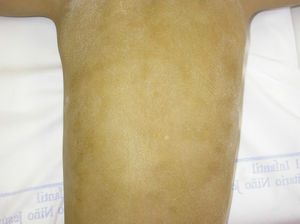 Hypohidrotic ectodermal dysplasia. The Minor test and the iodine-starch test show absent or decreased sweating in affected individuals. Almost complete absence of sweating was observed on the trunk of this patient.