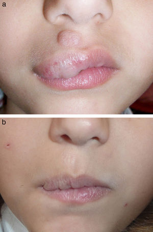 A, Patient number 4 with an involuting infantile hemangioma on the upper lip before treatment. B, Marked improvement without residual scarring, despite ulceration of the labial mucosa, after 1 treatment session.