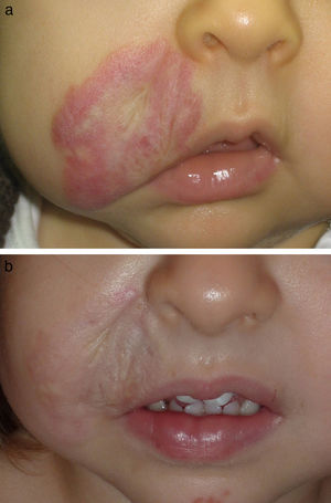 A, Patient number 6 with an involuting infantile hemangioma on the face. B, Good response of the vascular component after 2 treatment sessions.