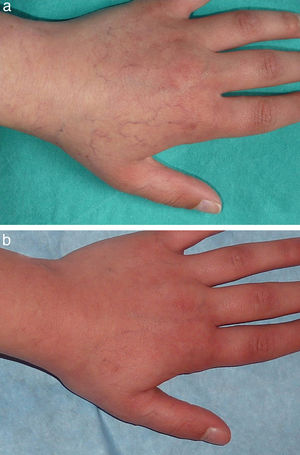 A, Patient number 22 with residual telangiectasias secondary to hemangiomas on the left upper limb. B, Near resolution of the telangiectasias after 1 treatment session.