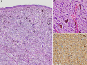 A, Clearly defined nodular lesion in the dermis, separated from the epidermis by a Grenz zone. The nodule is composed of atypical melanocytes and shows no signs of regression, ulceration, or any epidermal component (hematoxylin-eosin, original magnification ×200). B, Detail showing atypical cells and mitotic figures (mitotic index, 2/mm2) (hematoxylin-eosin, original magnification ×400). C, HMB45 stain.