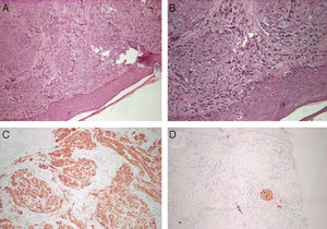 A, hematoxylin-eosin, original magnification ×10. B, hematoxylin-eosin, original magnification ×20. C, smooth muscle actin, original magnification ×10. D. Desmin, original magnification ×10.