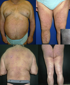 Extent of the skin condition before treatment. Inset: Detailed image of the lesions on the thigh.