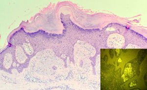 Compact orthokeratotic hyperkeratosis, irregular acanthosis, and deposits in the papillary dermis that caused widening of the papillae with lateral shift of the epidermal ridges (hematoxylin-eosin, original magnification x100). Inset: Deposits of amyloid material in the papillary dermis showing green fluorescence (thioflavin T, original magnification x200).