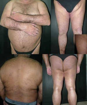 Improvement in lesions after completing treatment with narrowband UV-B therapy (57 sessions). Inset: Detail of the lesions on the thigh.