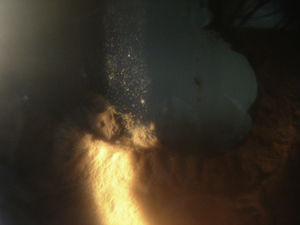 Tyndall phenomenon with the presence of posterior synechiae characteristic of anterior uveitis.