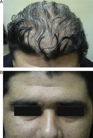 A, Diffuse rapid-onset alopecia on the scalp. B, Poliosis of the left eyebrow.