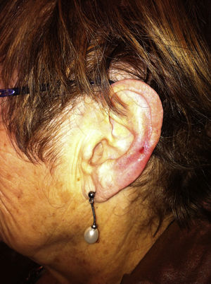 Erythematous ulcer on the helix of the left ear consistent with chondrodermatitis nodularis helicis.