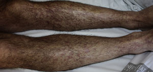 Multiple macules and papules, some confluent, on both legs.