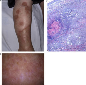 A, Yellowish atrophic plaques with raised and irregular erythematous borders on the right leg. B, Dermoscopy reveals irregular arborizing vessels on a light-brown background, whitish structures, and a patchy pigmented reticulum. C. Histology reveals abundant degenerated collagen in the dermis surrounded by palisading granulomas (hematoxylin-eosin ×40).