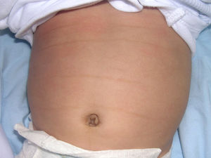Linear hyperpigmentation in the skin folds of the abdomen and diffuse hyperpigmentation of the navel.